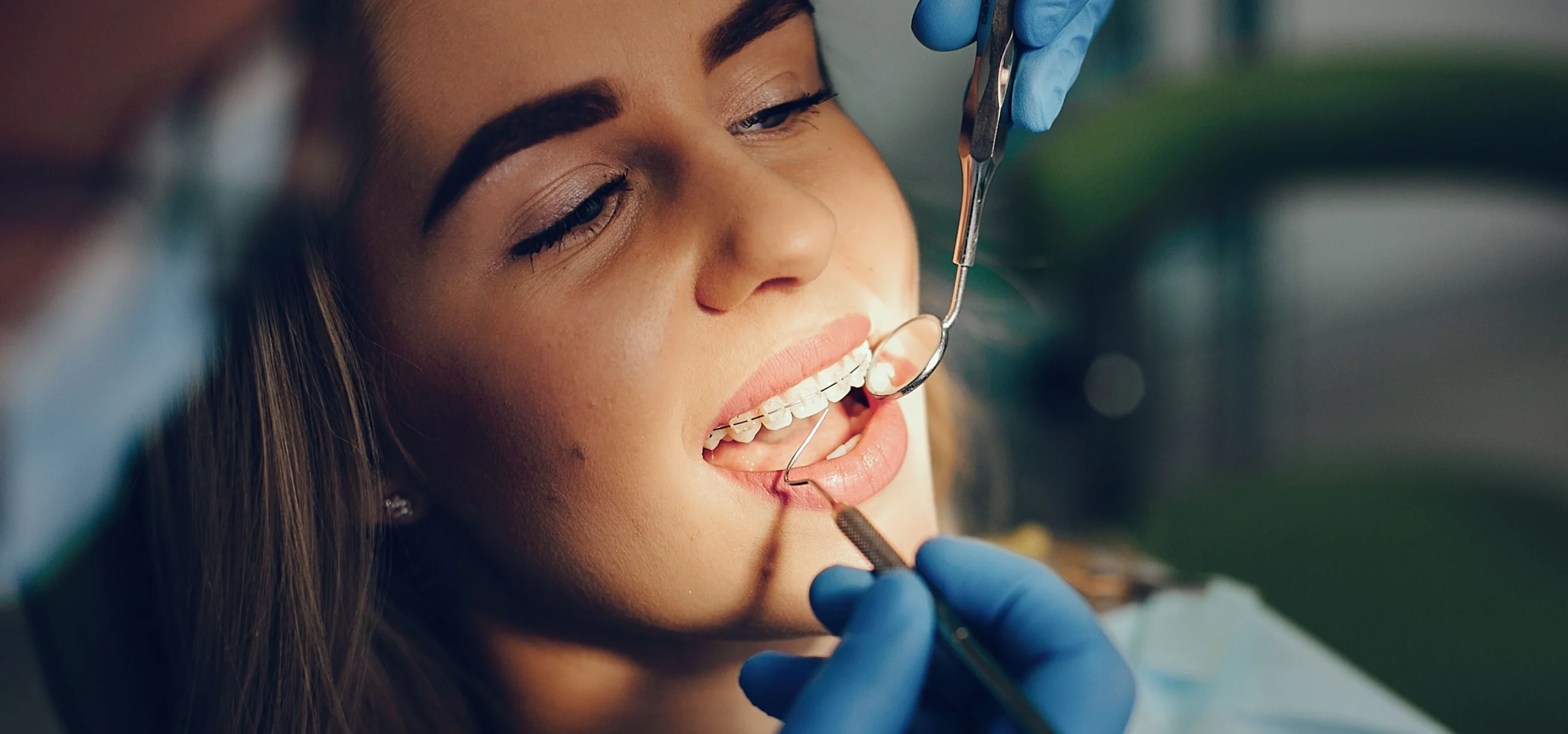 bagues dentaires classiques orthodontie troyes scaled